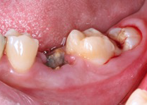自家歯牙移植治療症例
