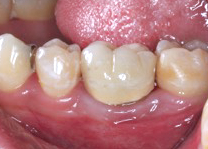 自家歯牙移植治療症例